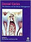 Dental Caries: The Disease and Its Clinical Management, (1405107189 