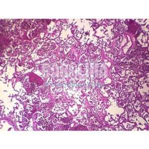Human Viral Pneumonia, Lung, sec. Microscope Slide, 7 u  